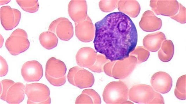 Εγκριση από τον FDA φαρμάκου για το λέμφωμα μανδύα